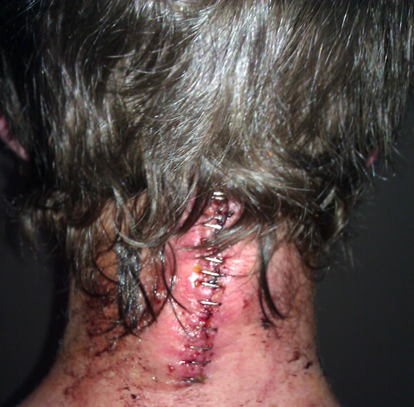 My neck after the surgery
